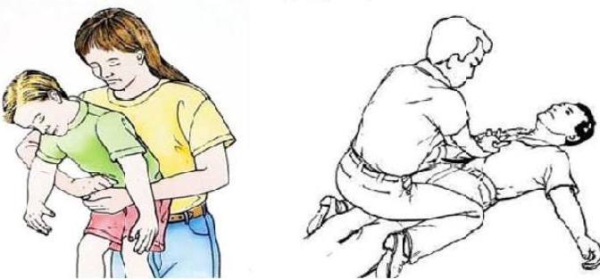 Sơ cứu hóc dị vật bằng thủ thuật Heimlich